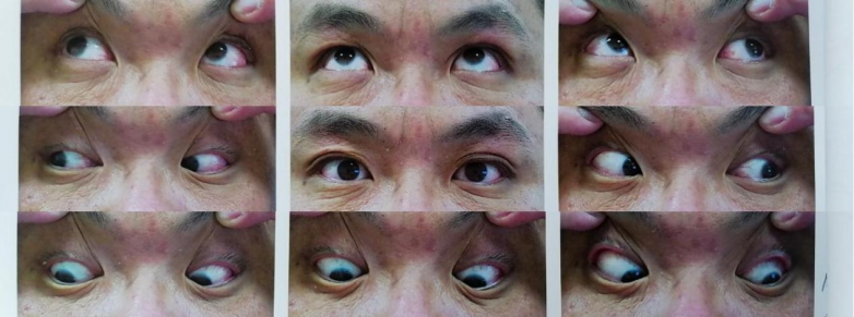 二十年“斜”路终修正！40岁高度近视患者在南昌爱尔重获清晰视