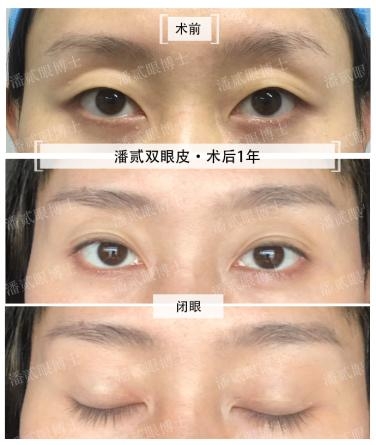 2025年度重磅眼整形决策工具书《一目了然·双眼皮成形术及“失败”修复全攻略》