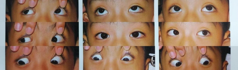 跨城诊疗暖人心:余新平教授南昌爱尔手术,7岁童先天外斜视康复 跨城诊疗暖人心:余新平教授南昌爱尔手术,7岁童先天外斜视康复