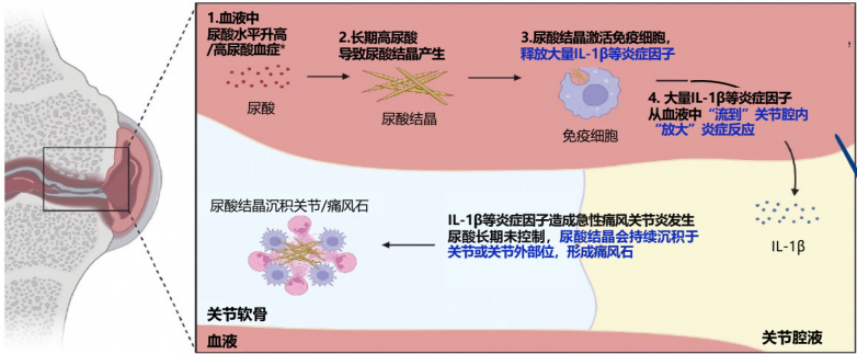 痛风合并症治疗：痛风新药物对肝肾及心血管更安全