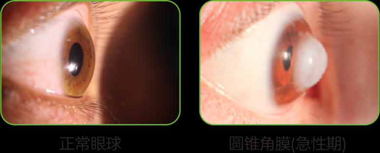 仁心换肯定|大理爱尔眼科为14岁藏族少女开展胶原交联手术