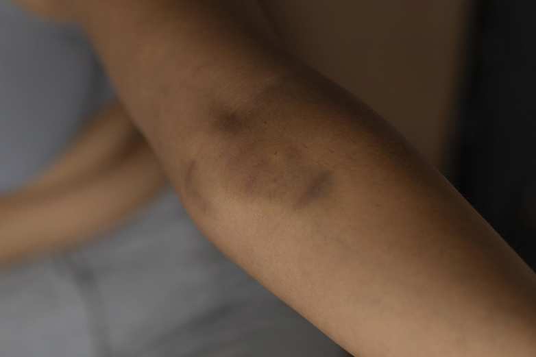 正骨紫金丸：一方源自清代医书的骨科用药