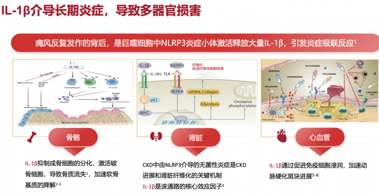 痛风反复发作找不到“特效药”？从机制
