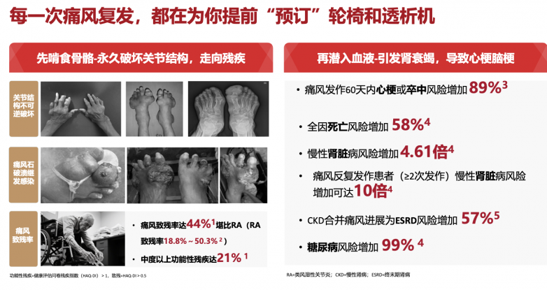 痛风发作吃什么药？安全性与有效性的平