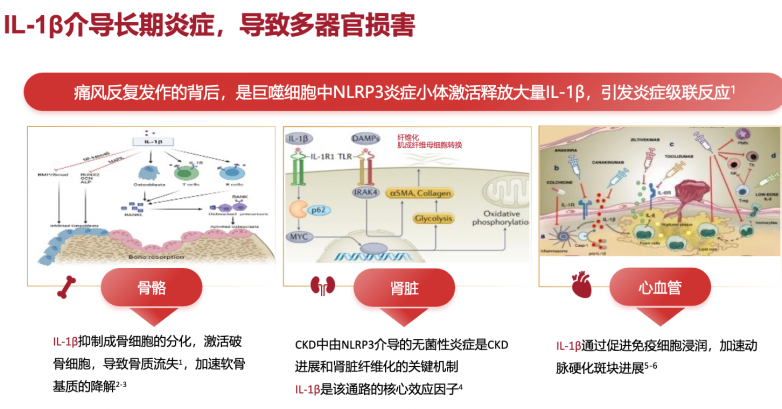 痛风反复发作：哪些药物值得关注？