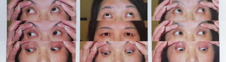 40年眼疾一朝除！中山眼科余新平教授南昌爱尔成功矫治53岁患者间歇性外斜视