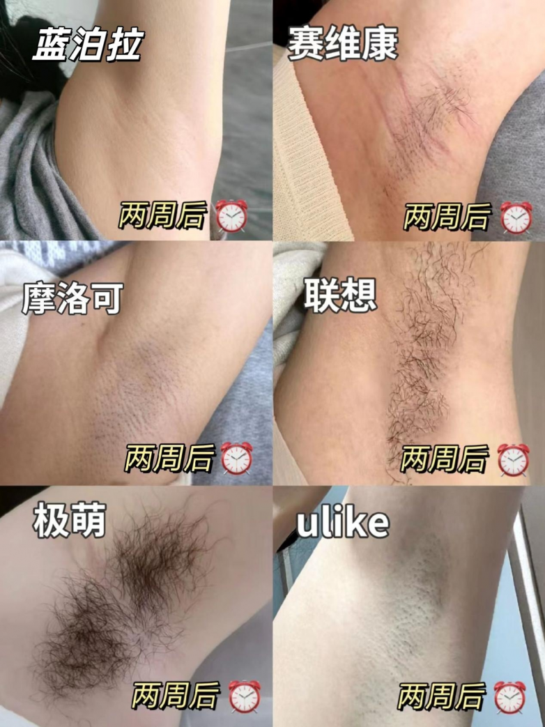 在家实现脱毛自由，脱毛器哪个牌子的好？2026脱毛仪推荐排行榜！