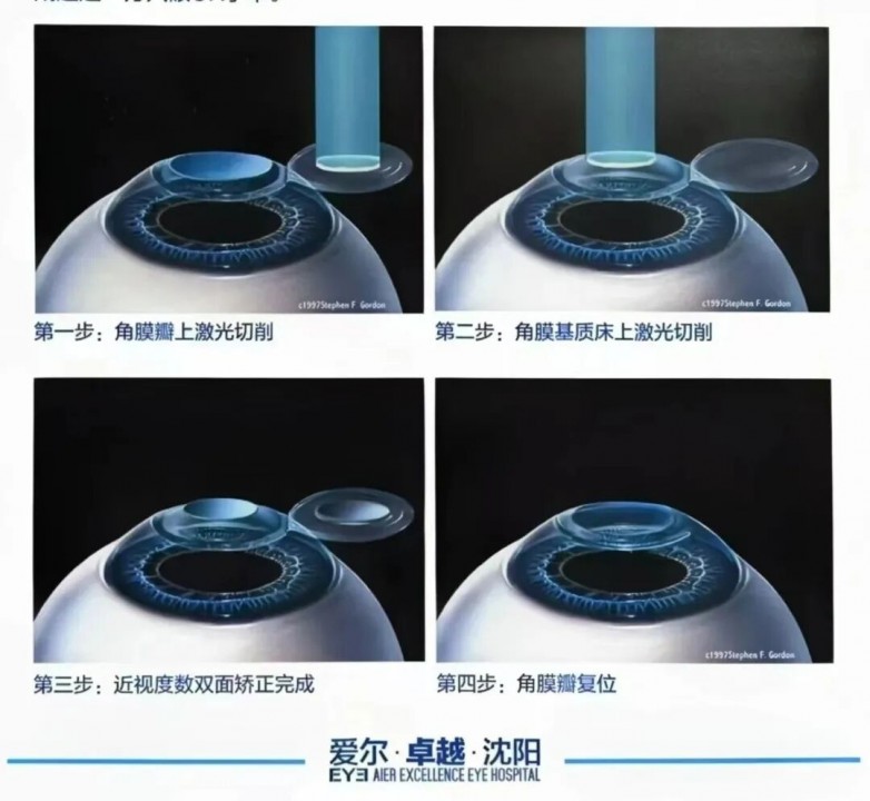 专攻疑难摘镜！张振华教授LASUK术式为高度近视疑难患者定制专属方案