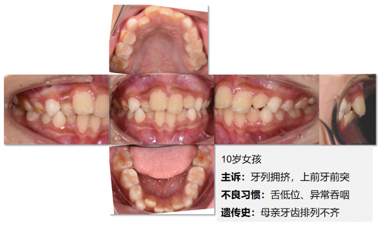 友睦口腔黄小瑶：替牙期牙齿拥挤，等还是不等？10岁女孩双期矫正治疗的决策启示