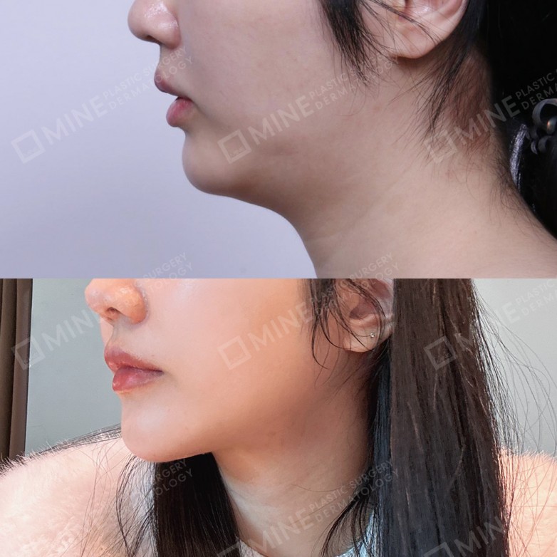 ✨双下巴不仅仅是脂肪的问题！✨
