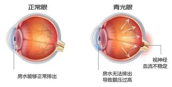 被“吃”掉的视力——快递员习惯性暴食引发难治性青光眼