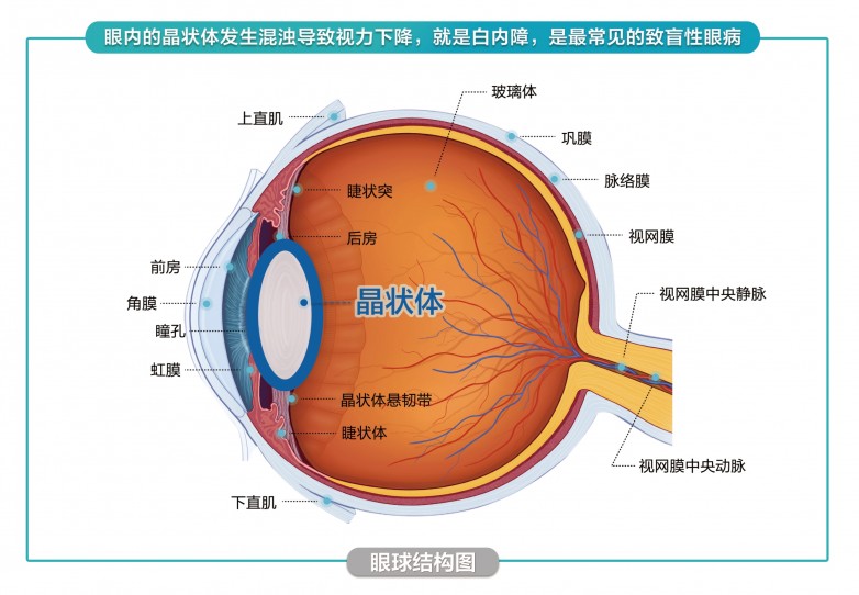 关于治疗白内障，这些核心要点你需了然于心！