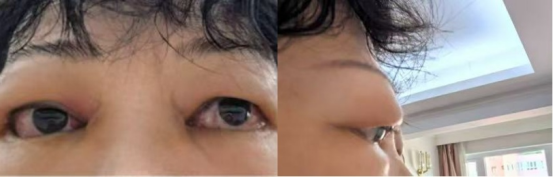 深圳爱尔眼科首例替妥尤单抗治疗告捷：六旬甲亢突眼患者重获“光明新生”