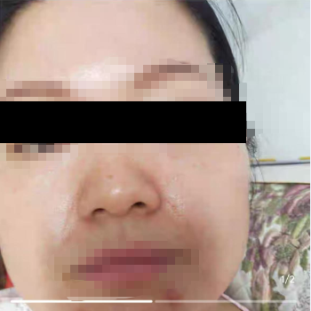 产品用于淡斑美白场景图