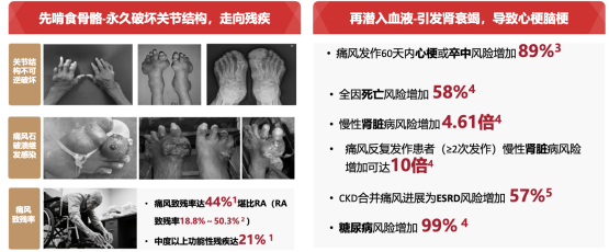 为什么降尿酸药一吃就痛？医生教你三招